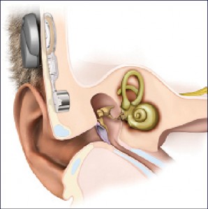 Bonebridge—a hearing implant launched by Med-El