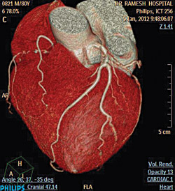 Fig. 2: iDose4 images of the heart showing calcification and narrowing of coronary arteries