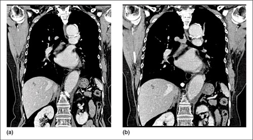 Fig. 1: (a) Full dose images (FBP - filtered back projection), (b) iDose4 images (80% less dose)