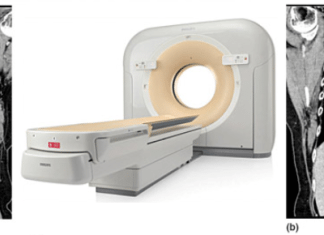 Radiation-A Concern, iDose4-The Solution