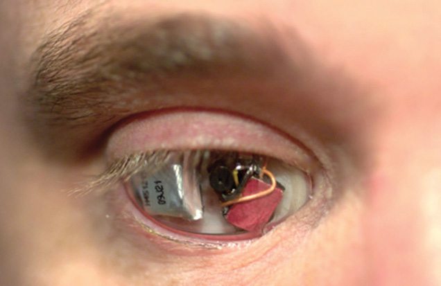 Fig. 4: A man wearing a specialised camera for an eye (Image courtesy: s.telegraph.co.uk)