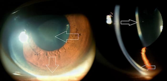 Glaucoma Detection Using Support Vector Machine Algorithm