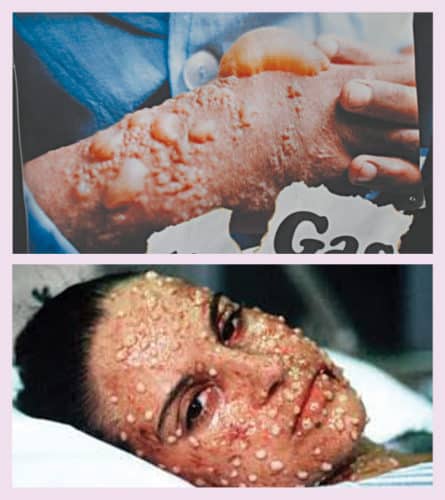 Effects of chemical weapon attack