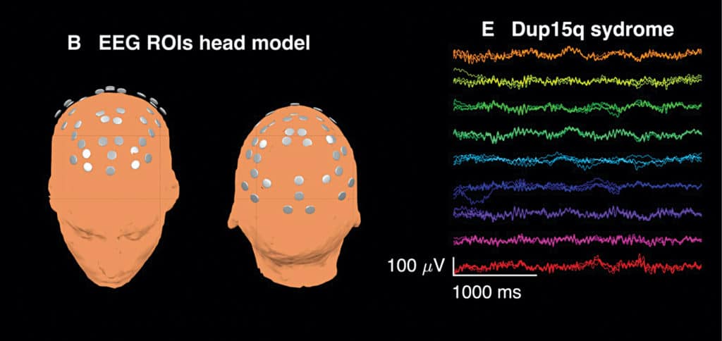 Diffuse beta waves present alongside other frequencies in spontaneous EEG recorded from a 28-month-old child with Dup15q syndrome (Credit: https://commons.wikimedia.org)