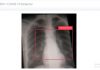 X-Ray-Based Quick COVID-19 Detection With Raspberry Pi