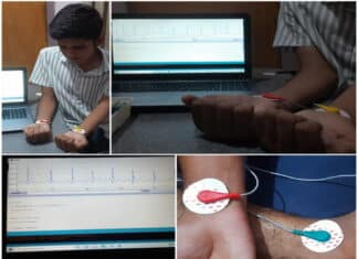 Figure 7: Connections of the red, yellow and green electrodes at RA, LA and RL respectively