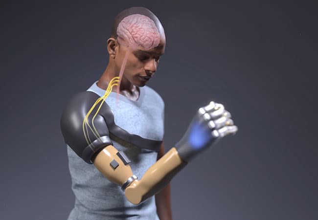 Neuro-Robotic Bionic Arm Restores Natural Arm Movement
