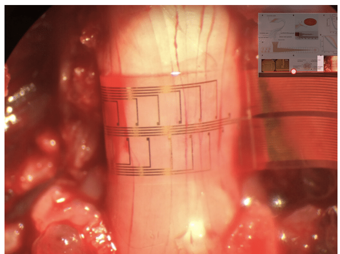 Flexible Electronic Device For Spinal Injury Treatment Flexible Electronic Device For Spinal Injury Treatment