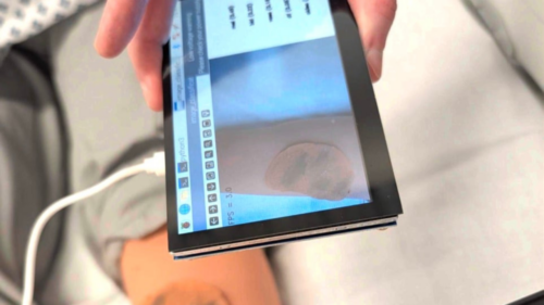 Close-up of the LesionIQ device screen showing real-time image classification of a skin lesion