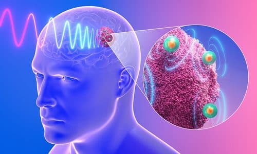 This illustration depicts injectable nanoantennas being wirelessly activated by a magnetic field to generate localised electric fields that target a brain tumour. The magnified inset shows nanoparticles interacting with drug-resistant glioblastoma tissue. Image Credit: Baju Joy and Gopikrishna Pillai